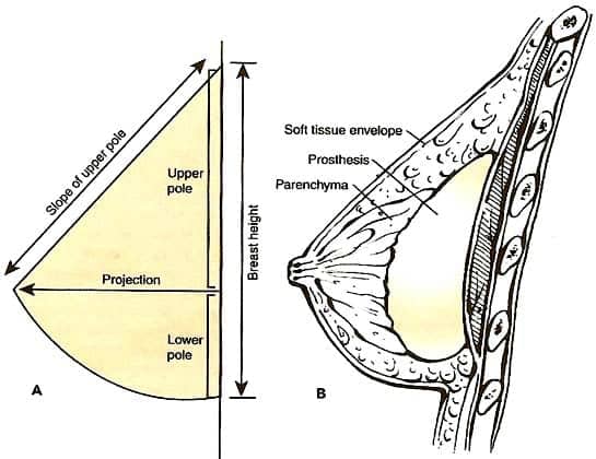 Slope of the upper breast. Q6. What is the most ideal slope of the