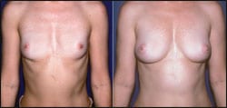 Breast Augmentation Via Fat Grafting