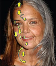 Vectors of Facial Aging and Their Reversal