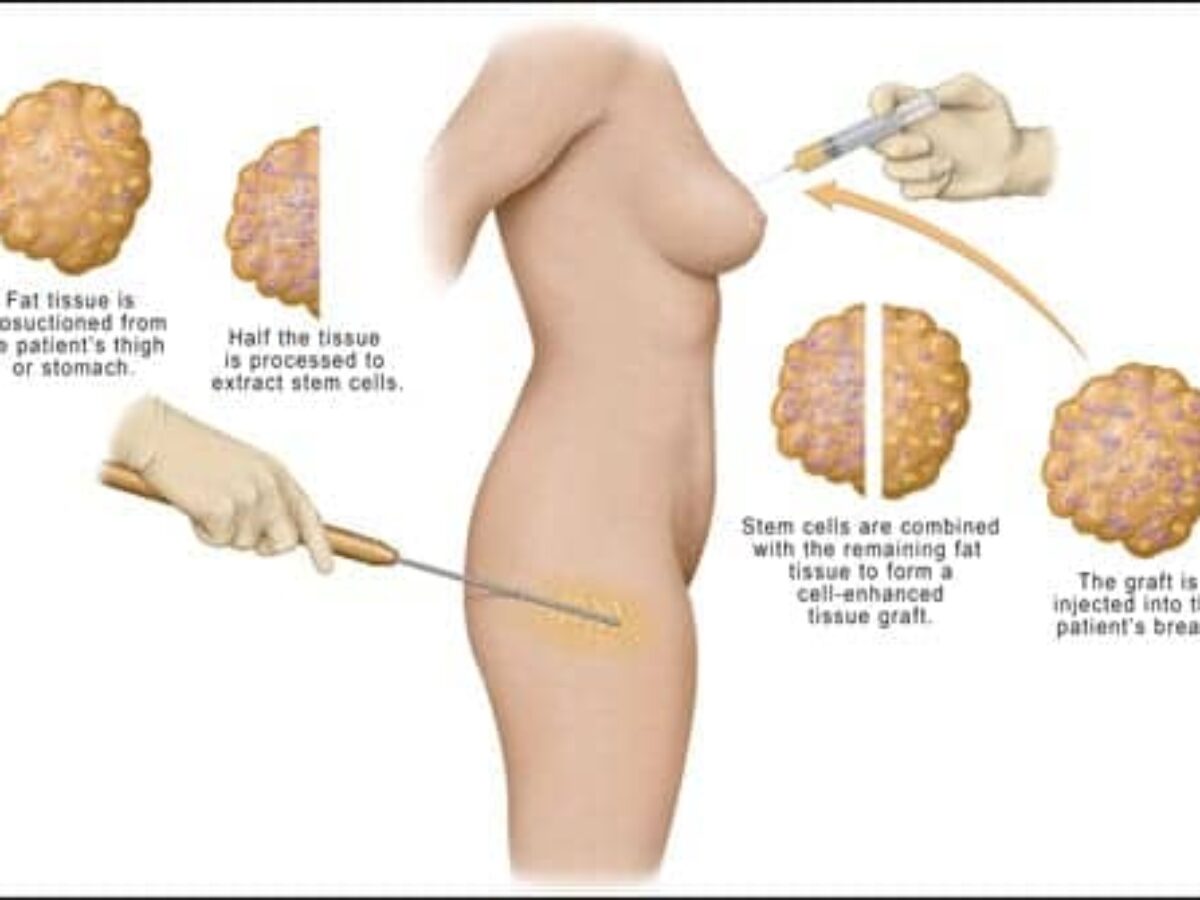 Using Stem Cells in Breast Augmentation - Plastic Surgery Practice