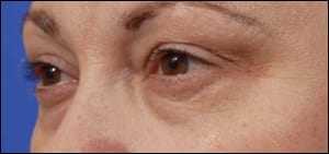 An Affordable, Nonsurgical Blepharoplasty Procedure