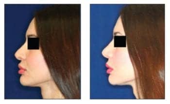 Rhinoplasty Upscaled