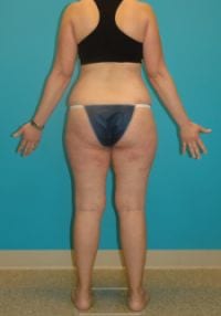 The Truth About Laser Lipolysis