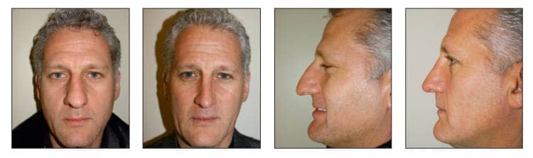 A Modern Approach to Natural-Looking, Long-Lasting Rhinoplasty Results