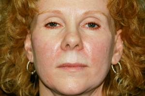 “Facial Revolumizing”  Using Dermal Fillers