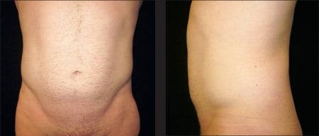 Liposculpture Versus Liposuction