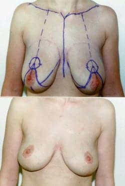 The Evolving Breast-Reduction Procedure