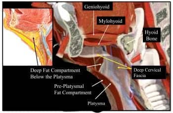 Isolated Submentoplasty Versus Facelift with Submentoplasty