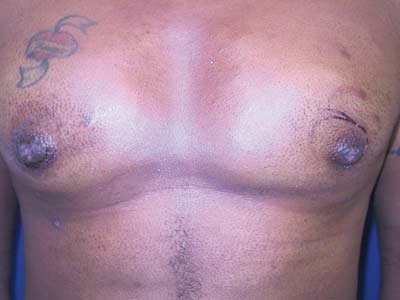 Aesthetic and predictable correction of the inverted nipple