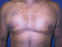 Aesthetic and predictable correction of the inverted nipple