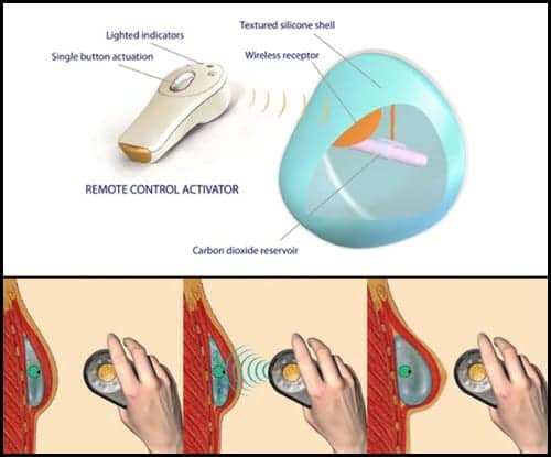 Smooth Shell Version of AeroForm Tissue Expander Receives FDA Approval