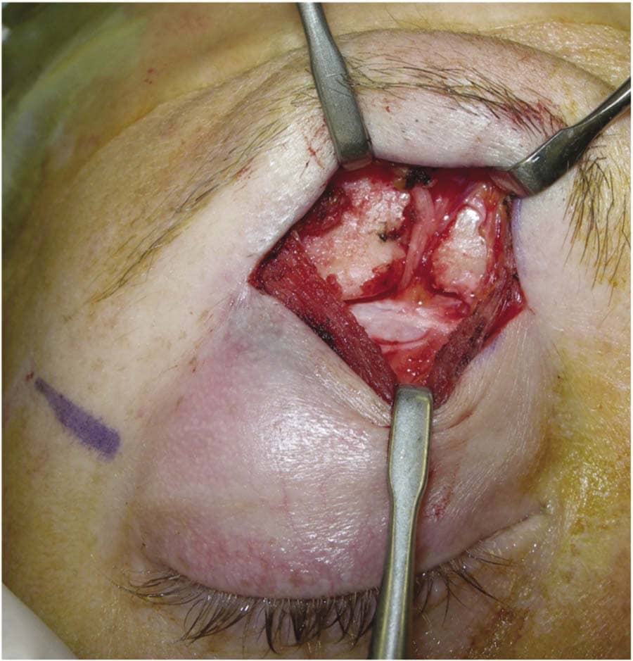 Migraine-Supraorbital nerve dec opt2