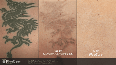 THE SKIN: Game Change: PicoSure Revolutionizes Laser Tattoo Removal