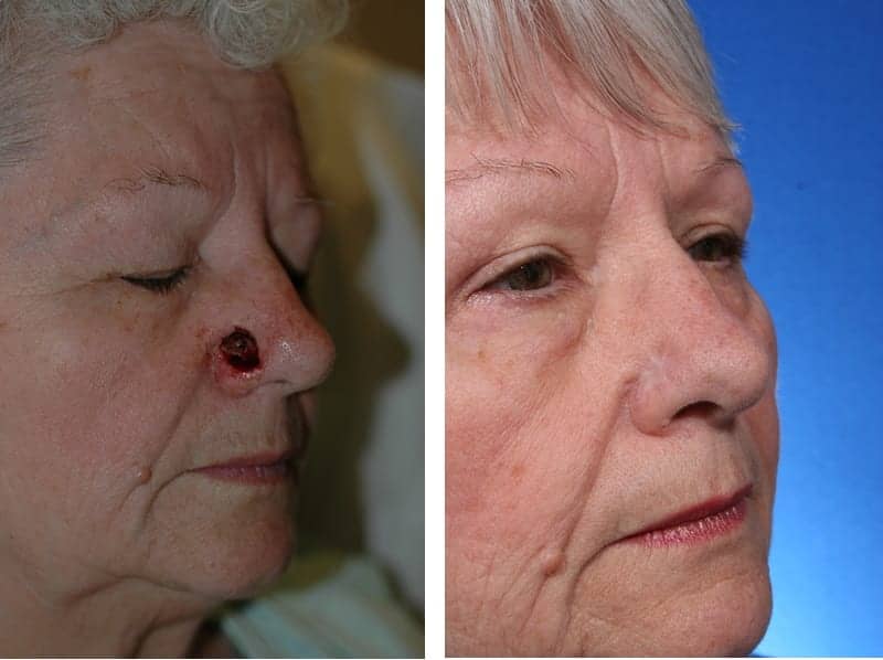 New Procedure Can Repair Skin Cancer on the Nose in One Step