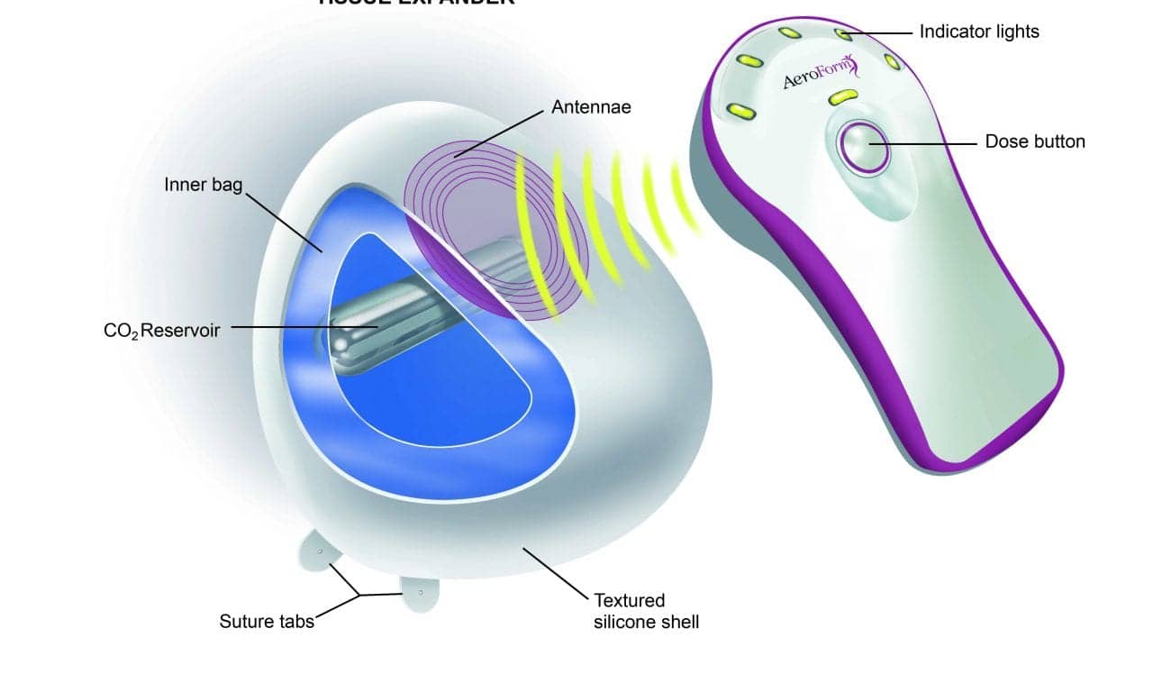 AirXpanders Inc Aeroform Decreases Time to Breast Reconstruction