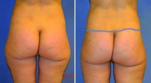 mommy makeover body lift posterior view