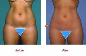 mommy makeover lipo