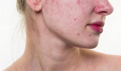 Certain foods May Be Causing Your Acne: A Dermatologist Explains