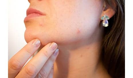 6 Types Of Pimples & What They Mean About Your Skin According To A Dermatologist