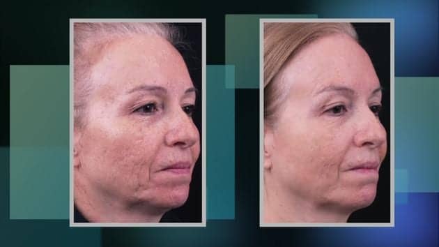 Meet Instalift, the Facelift with No Recovery Time