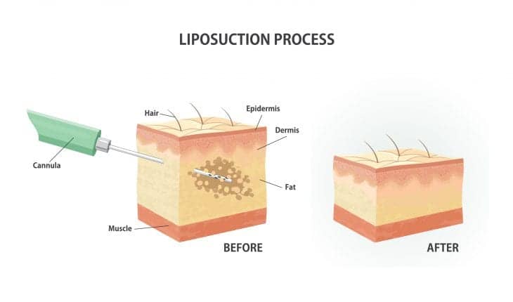 10 Liposuction Myths Debunked