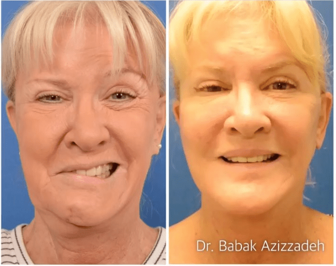The Facial Nerve Surgery That Finally Fixed Mary Jo Buttafuoco’s Lopsided Smile