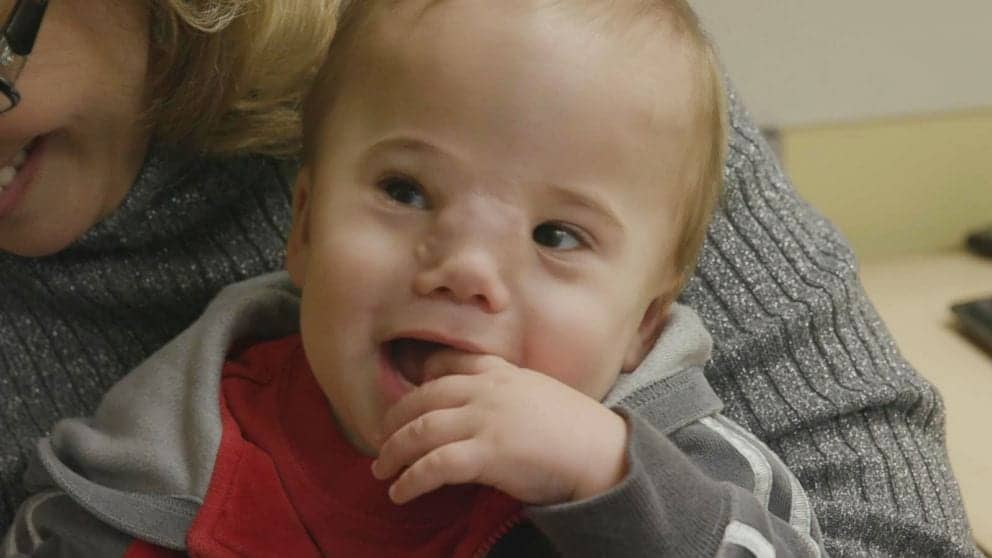 Doctors Reveal Baby’s Face Through Life-Altering Surgery