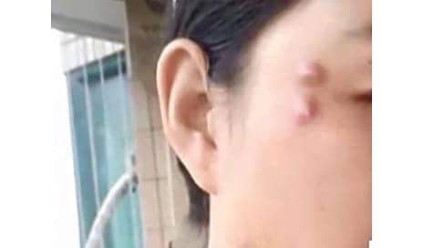 Woman is Left with Large Lumps on Her Face That Move Around After Botched Plastic Surgery in China