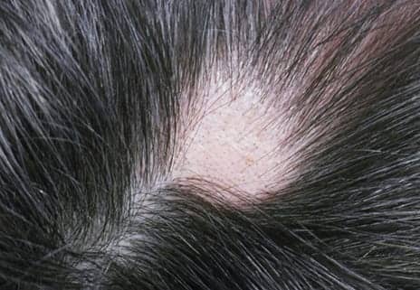 Cyclosporin Is Moderately Effective for Alopecia, Study Notes