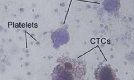 Sensitive, Noninvasive Platform Detects Circulating Tumor Cells in Melanoma Patients