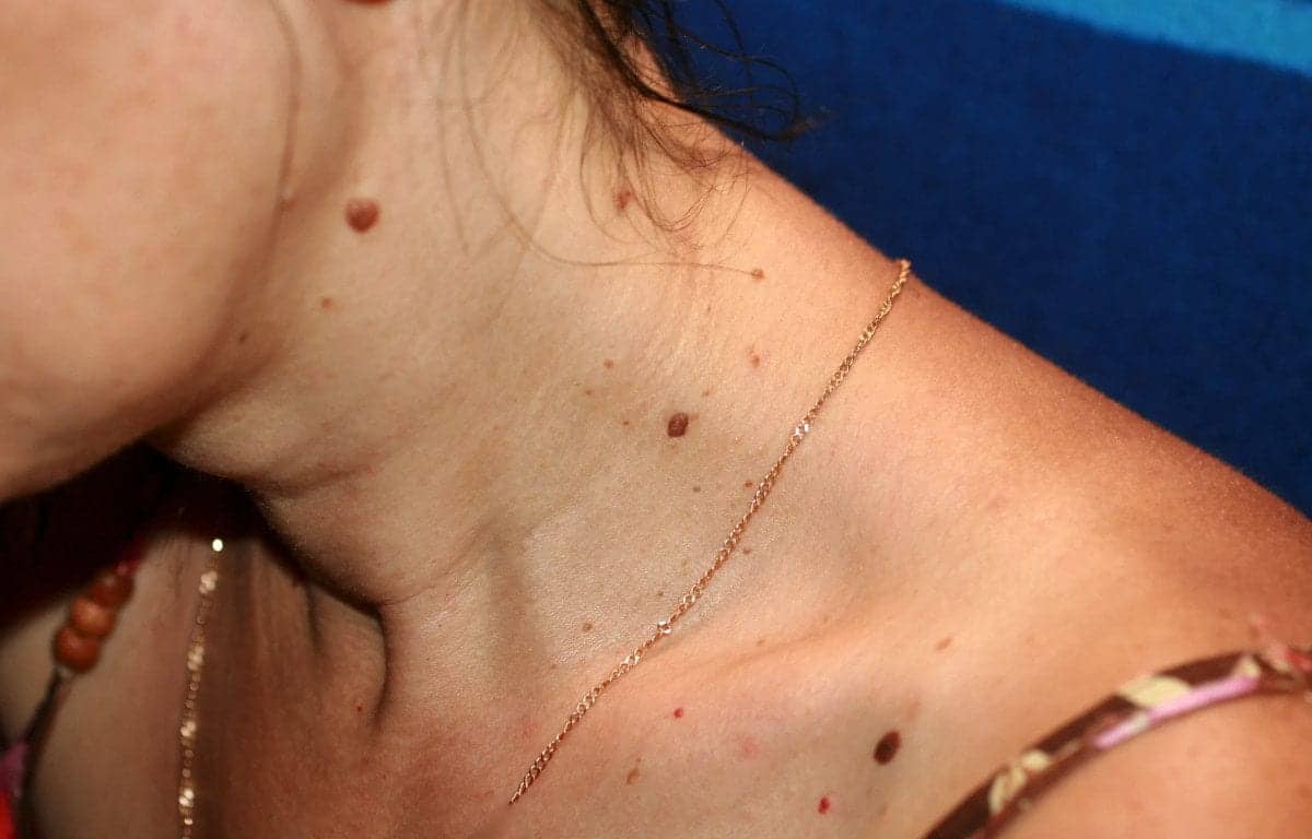 Moles on the Body Are Largely Influenced By Genetics, a New Study Finds