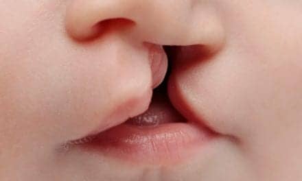 Study Looks at Speech Impairment in Children with Cleft Palate