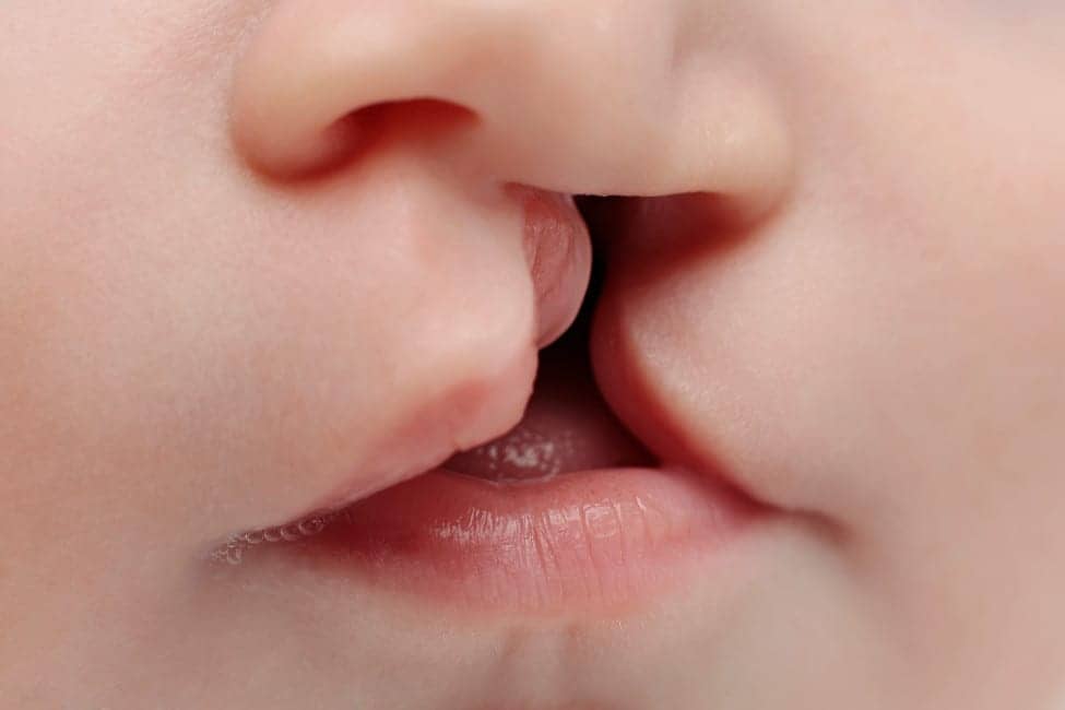 Cleft Lip Caused by Combination of Genes and Environment