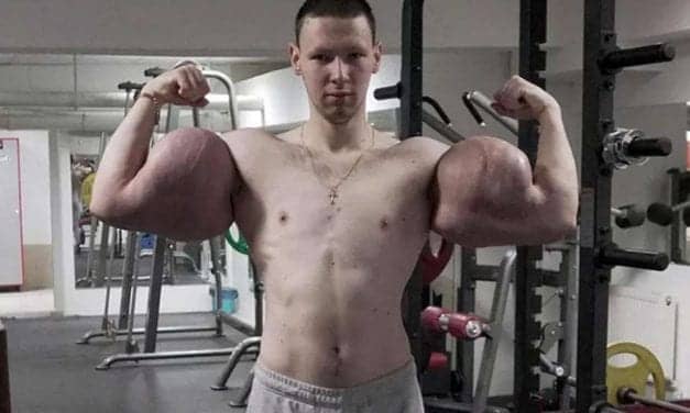 Russian ‘Popeye’ Has Life-Saving Surgery to Remove Chemicals from His Biceps