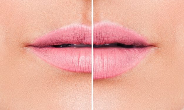 Lip Implants vs Injected Lip Fillers