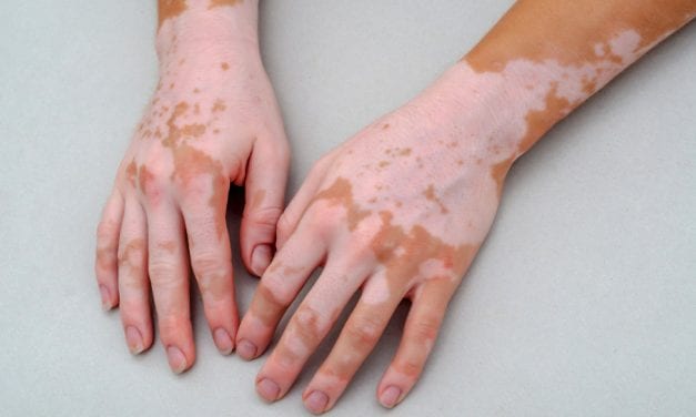 Topical Tofacitinib Safe and Effective for Treatment of Refractory Vitiligo