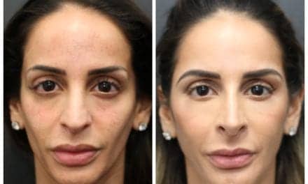 Why the Y-Zone Is a Mistake for Facial Injections, According to One Plastic Surgeon