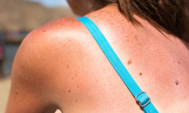 Survey: 60% of Americans Say They Have Gotten So Badly Sunburned Their Clothes Were Uncomfortable