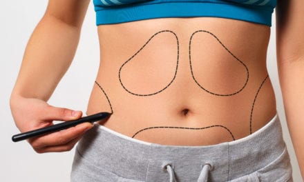 6 Plastic Surgeons Reveal the Biggest Misconceptions Patients Have About Liposuction