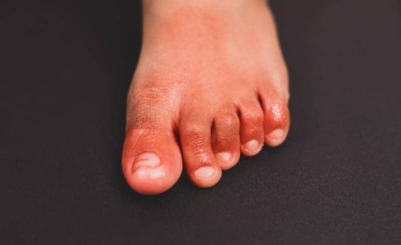 COVID Toes Are Caused By Coronavirus Infecting The Lining Of Blood Vessels, Says New Study