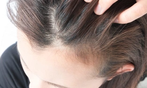 Frontal Fibrosing Alopecia in Women Linked to Autoimmune Disease, Thyroid Abnormalities