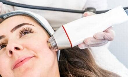 All About Radiofrequency Microneedling