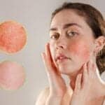 COVID-19 Mask Wearing Could Be Worsening Rosacea