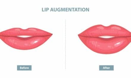 What Exactly Is a Lip Lift? Plastic Surgeons Explain