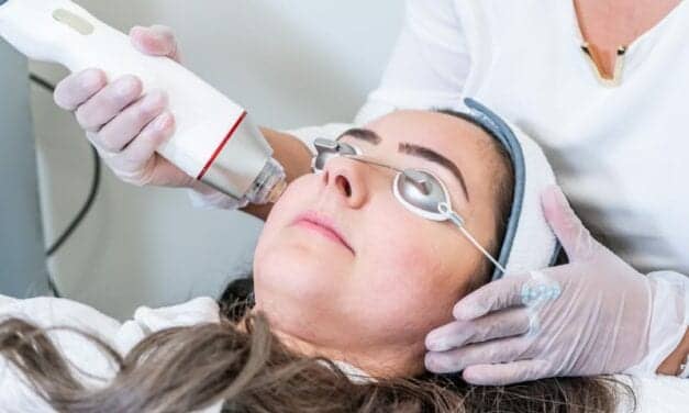 Everything You Need to Know About Radiofrequency Microneedling for Acne Scars