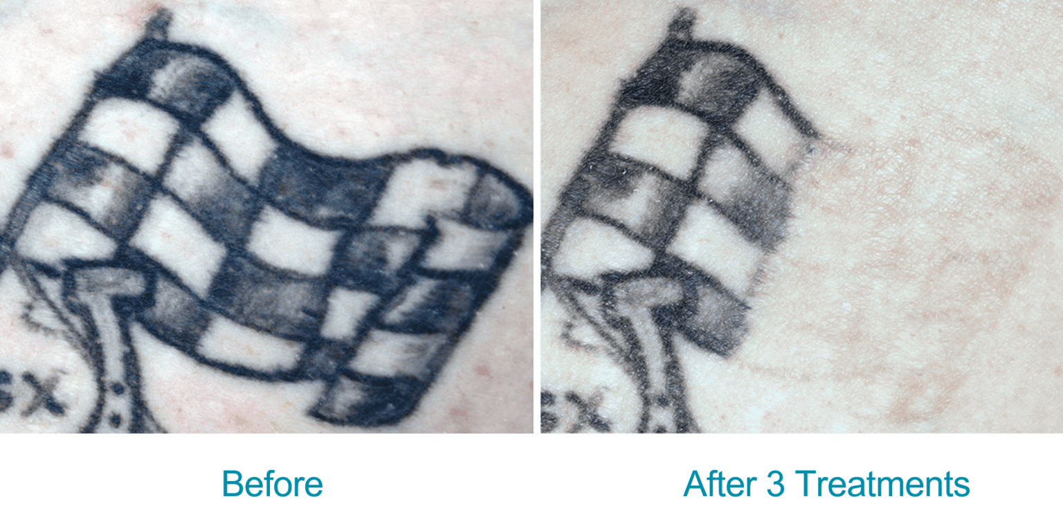 Soliton Will Deliver RESONIC Dual-Platform Device June 2021 - Plastic