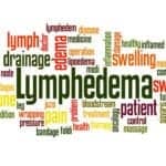 What You Need to Know About Lymphedema