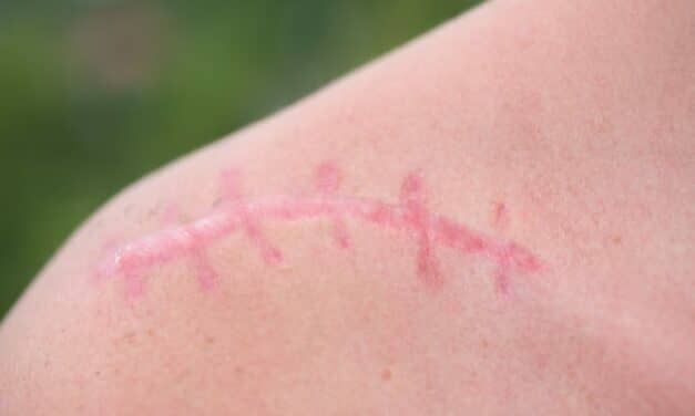 How This Molecule Improves the Appearance of Surgery Scars