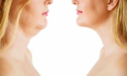 A Chin Liposuction Specialist Answers 5 Common Questions About The Procedure