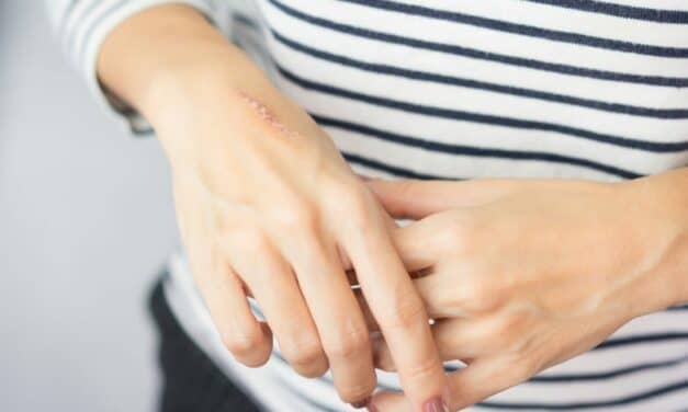 How to Get Rid of Scars, According to Dermatologists
